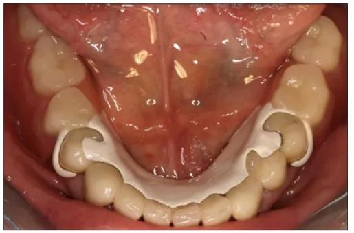 下颌peek支架可摘局部义齿与传统钴铬合金支架的活动义齿相比,peek